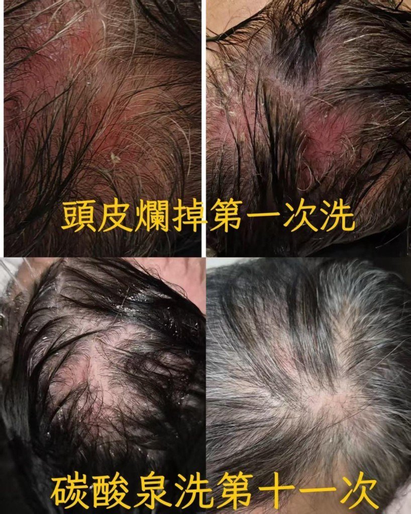 頭皮爛掉第一次洗，對比碳酸泉洗第十一次後頭皮明顯改善